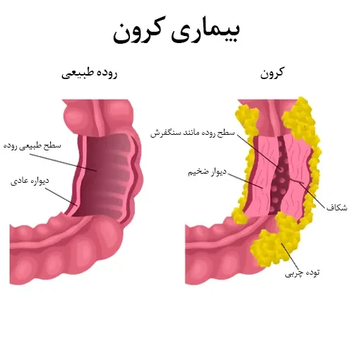 داروی نالدمدین در درمان بیماری کرون