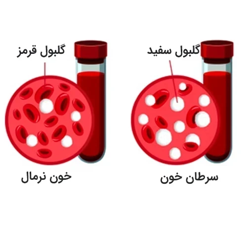 تاثیر نلارابین در درمان سرطان خون