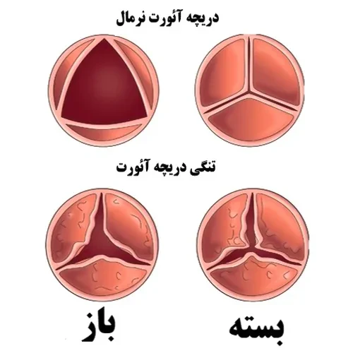 بیماری های قلبی از موارد احتیاطی مصرف داروی نیفدیپین