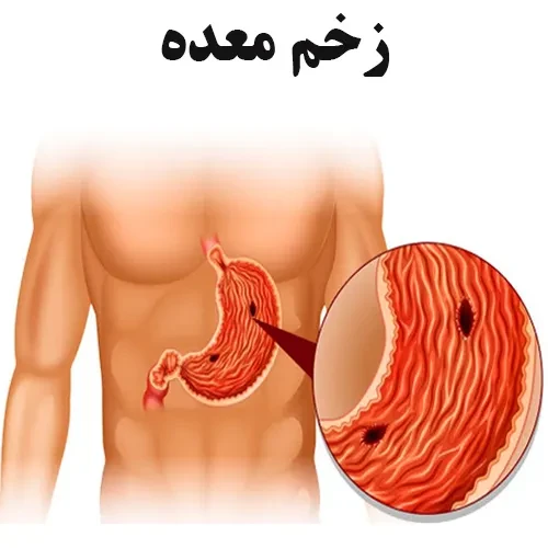 درمان زخم معده با داروی نیزاتیدین