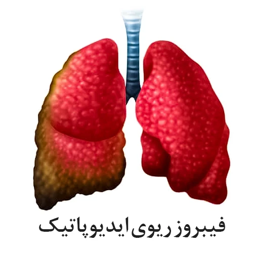 داروی اوفو (نینتدانیب) برای درمان برخی از بیماری های ریه