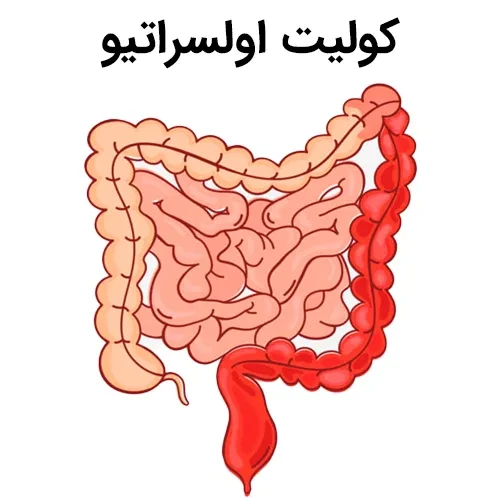 کنترل بیماری کولیت اولسراتیو با داروی اولسالازین