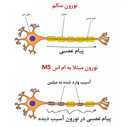 جلوگیری از آسیب به اعصاب با مصرف داروی اوزانیمود