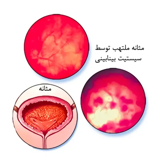 درمان مثانه ملتهب ناشی از سیستیک بینابینی با داروی پنتوسان پلی سولفات سدیم