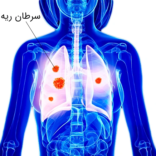 استفاده از دارو (نسیتوموماب) در درمان سرطان