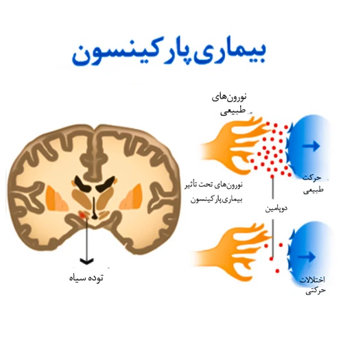 درمان بیماری پارکینسون با داروی پرامی پکسول