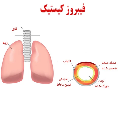 داروی پولموزایم (دورناز آلفا)  در فیبروز کیستیک