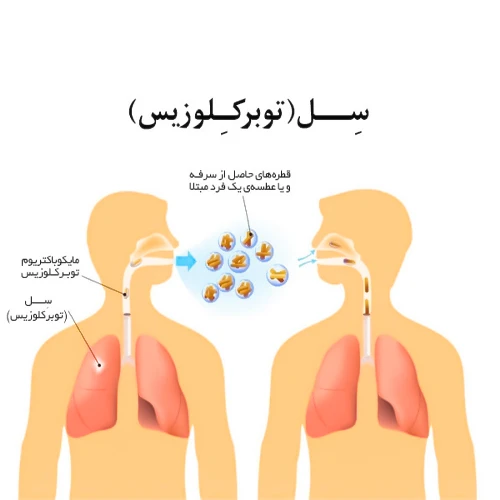 درمان بیماری سل با داروی ریفامپین