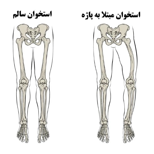 درمان بیماری پاژه با مصرف داروی ریزدرونات