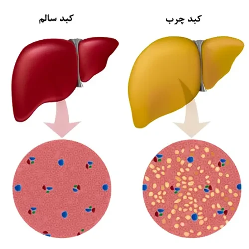 بیماری های کبدی از موارد احتیاطی مصرف داروی ریسپریدون