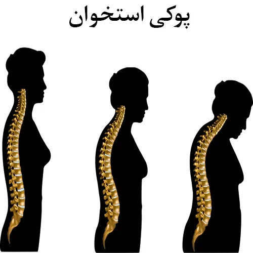 درمان پوکی استخئان با داروی روموسوزوماب