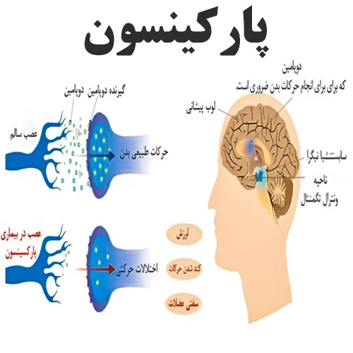 کنترل علائم بیماری پارکینسون با داروی روپینیرول