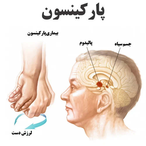 کنترل علائم پارکینسون با داروی روتیگوتین