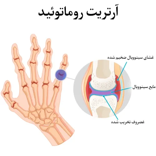 درمان آرتریت روماتوئید با داروی ساریلوماب