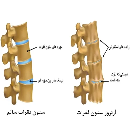 درمان برخی انواع آرتروز با داروی سکوکینوماب