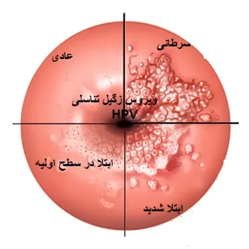 داروی سینکاتچینز برای درمان ویروس زگیل تناسلی