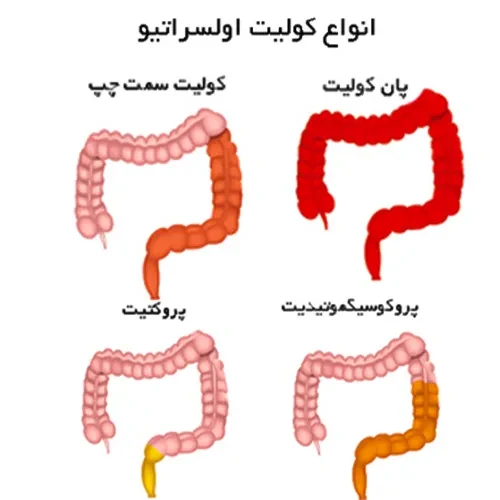 درمان کولیت اولسراتیو با داروی سولفاسالازین