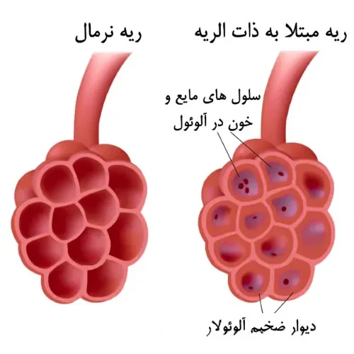 درمان بیماری ذات الریه با داروی تلاوانسین