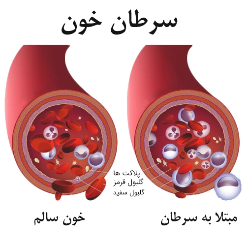 داروی تنی پوزاید موثر در درمان سرطان خون