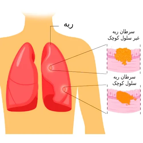 درمان سرطان سلول های غیر کوچک ریه با داروی تپوتینیب