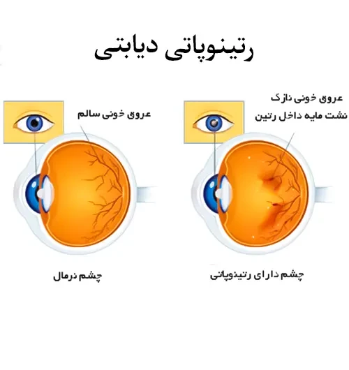 بیماری رتینوپاتی دیابتی از موارد احتیاطی مصرف داروی تینزاپارین