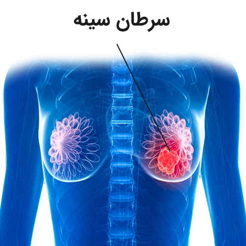 درمان سرطان سینه با داروی تورمیفن (Toremifene)