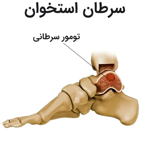 درمان سرطان استخوان با داروی تورمیفن (Toremifene)