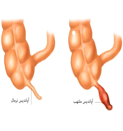 عارضه آپاندیسیت از موارد احتیاطی مصرف داروی تری متوبنزامید