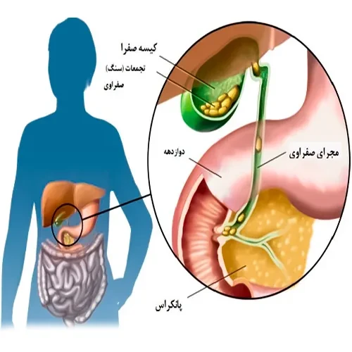 درمان مشکل سنگ صفرا با داروی اورسودیول