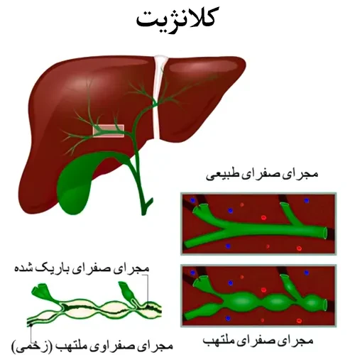 مشکلات مجاری صفراوی از موارد احتیاطی مصرف داروی اورسودیول