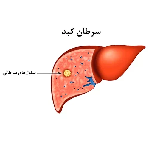  داروی یرووی (ایپیلیموماب)  موثر در درمان سرطان کبد