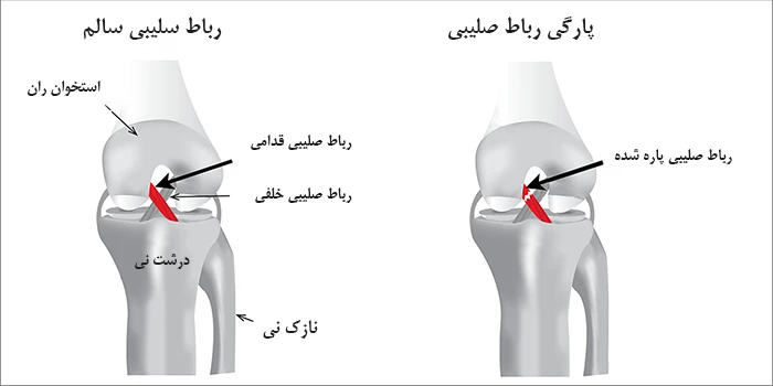 علائم آسیب دیدگی رباط صلیبی