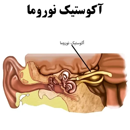 آکوستیک نوروما