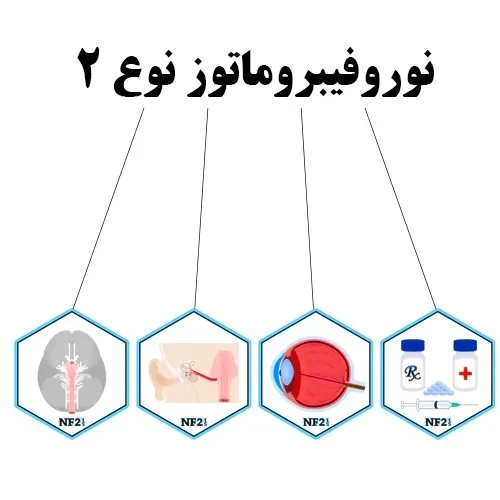 نوروفیبروماتوز نوع ۲ از عوامل خطر ساز ابتلا به آکوستیک نوروما