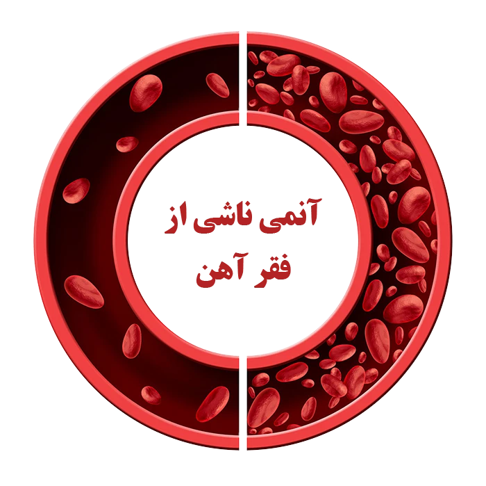 فقر آهن یکی از علل ابتلا به کم خونی (آنمی)