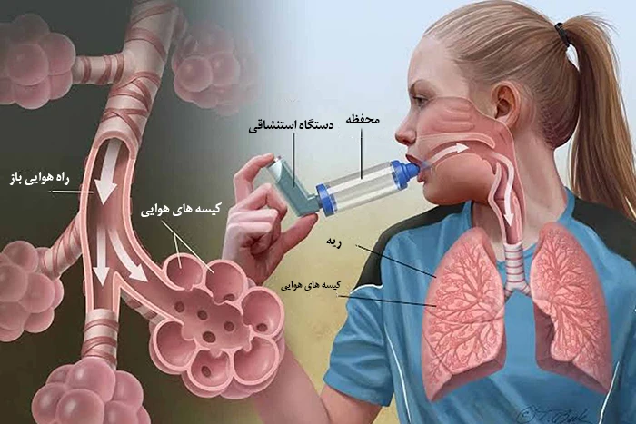 درمان بیماری آسم با اسپری استنشاقی