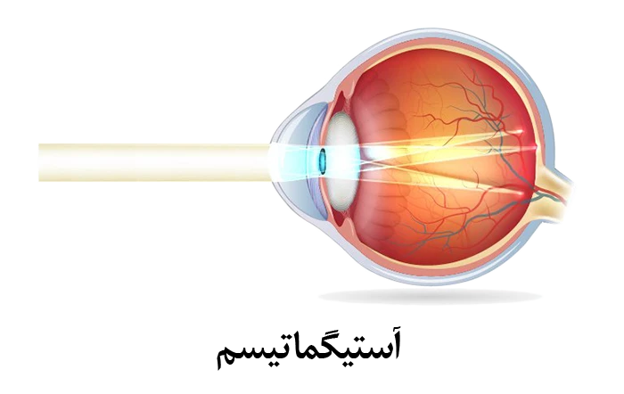 ناهمواری در سطح جلویی چشم علت ابتلا به آستیگماتیسم