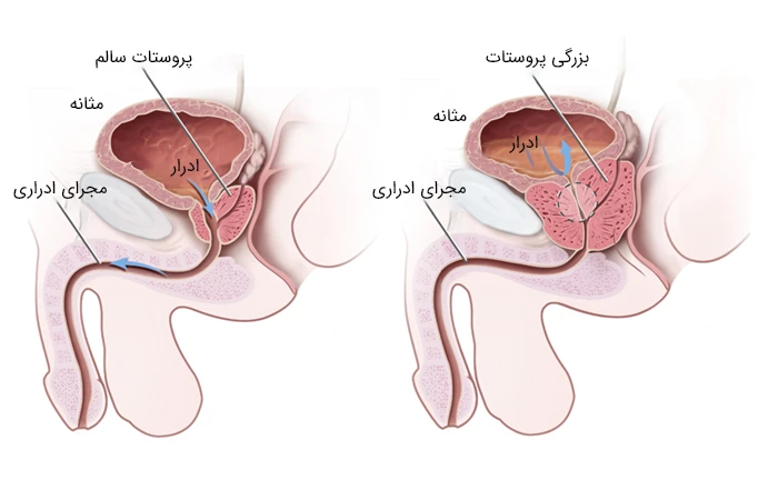 بزرگی پرستات در میانسالان