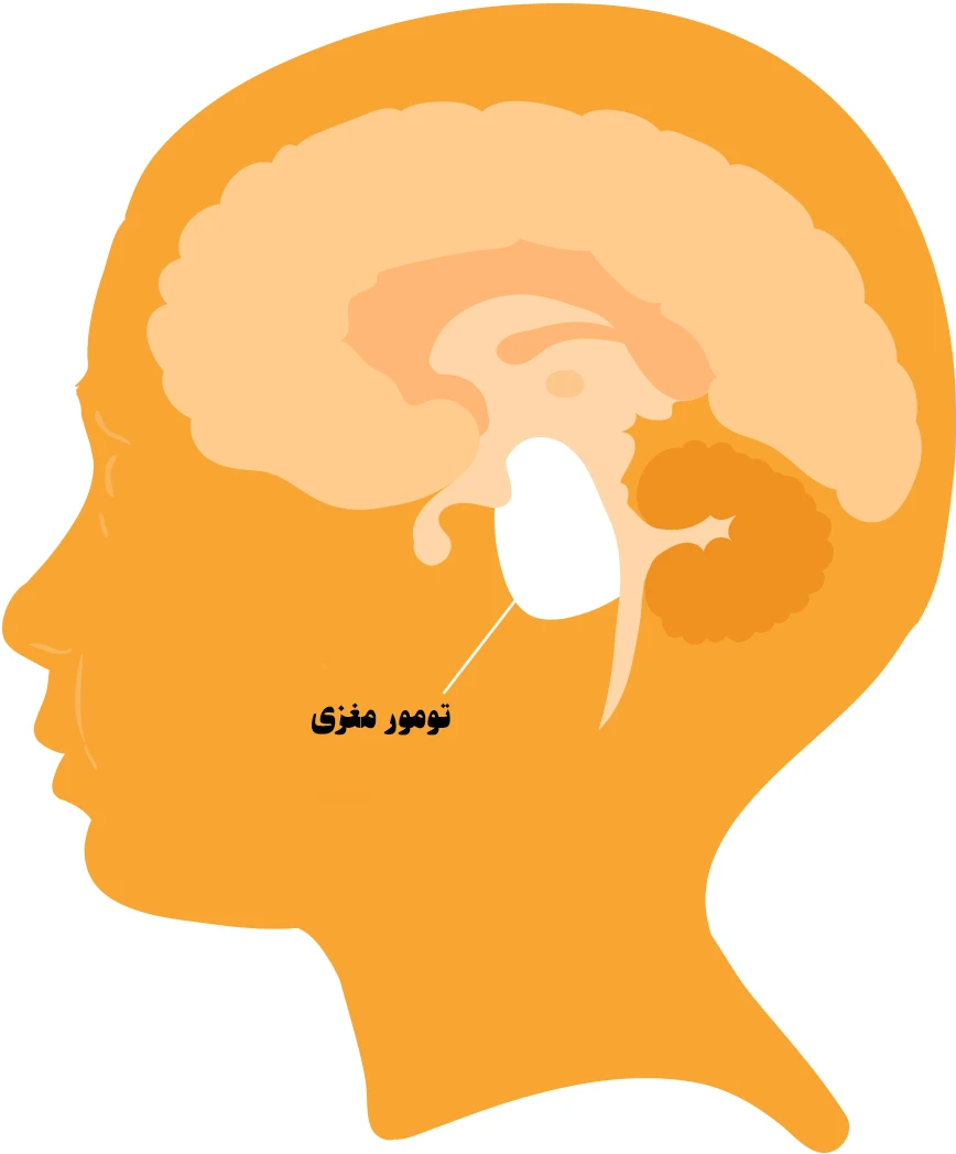 تومور های مغزی چیست؟