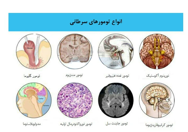 انواع تومور های سرطانی مغزی