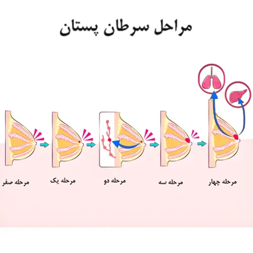 مراحل سرطان پستان