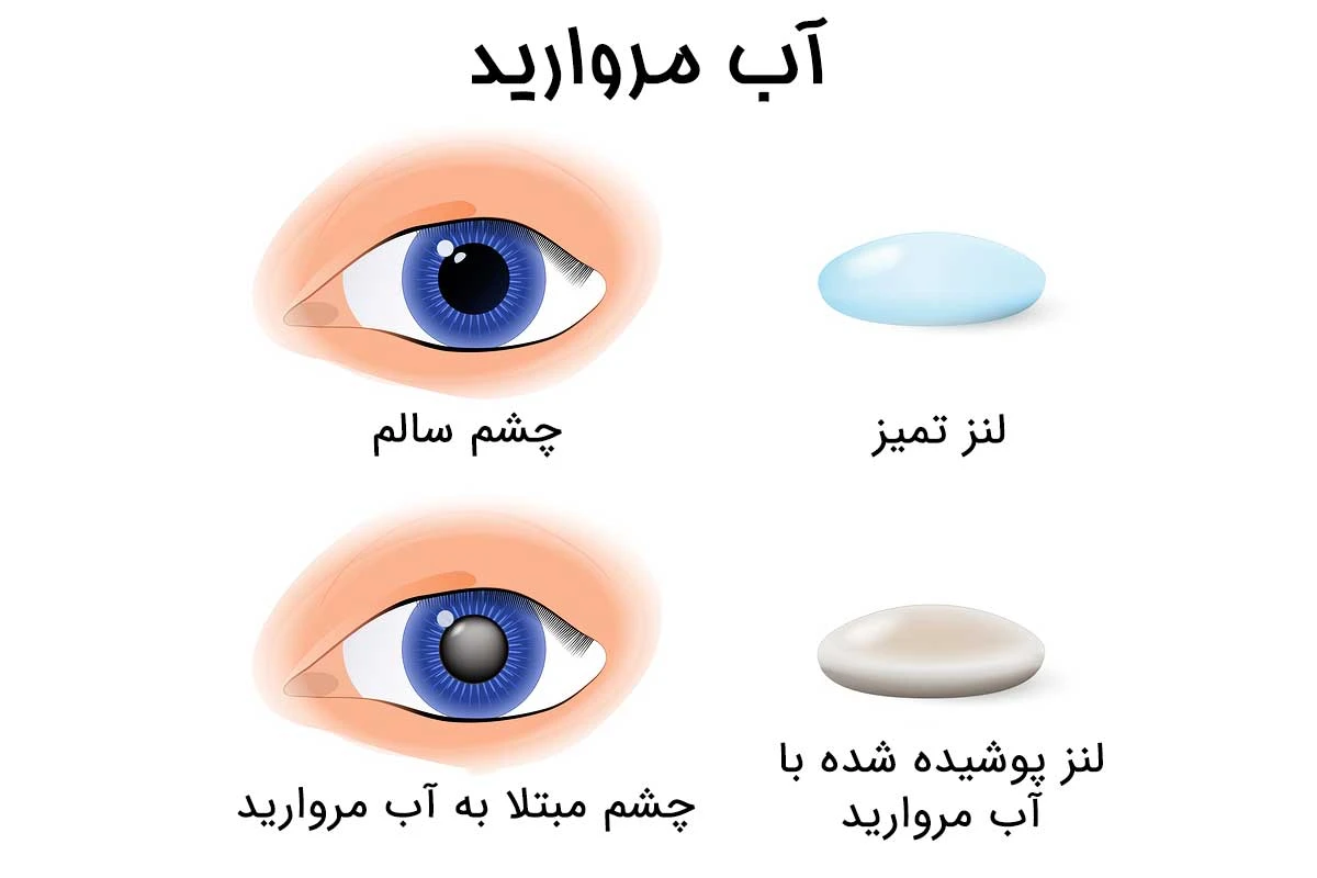 تفاوت عدسی چشم سالم با عدسی چشم مبتلا به آب مروارید