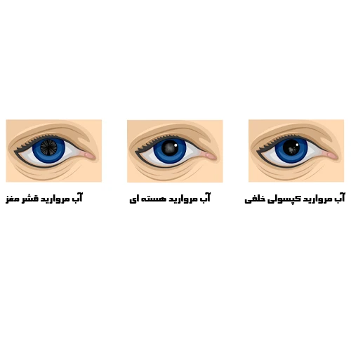 انواع آب مروارید 