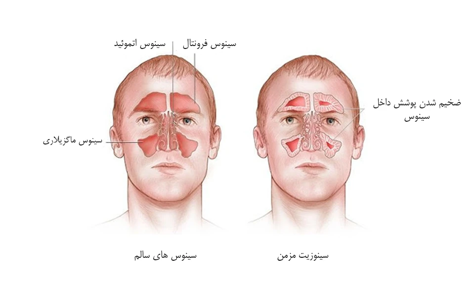 تورم صورت و اطراف چشم از علائم سینوزیت مزمن