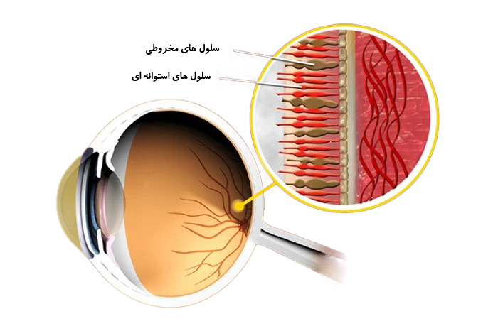 اختلالات ارثی از علل ابتلا به کوررنگی