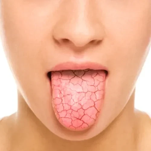 تشنگی شدید از علائم کمبود آب بدن (دهیدراتاسیون)