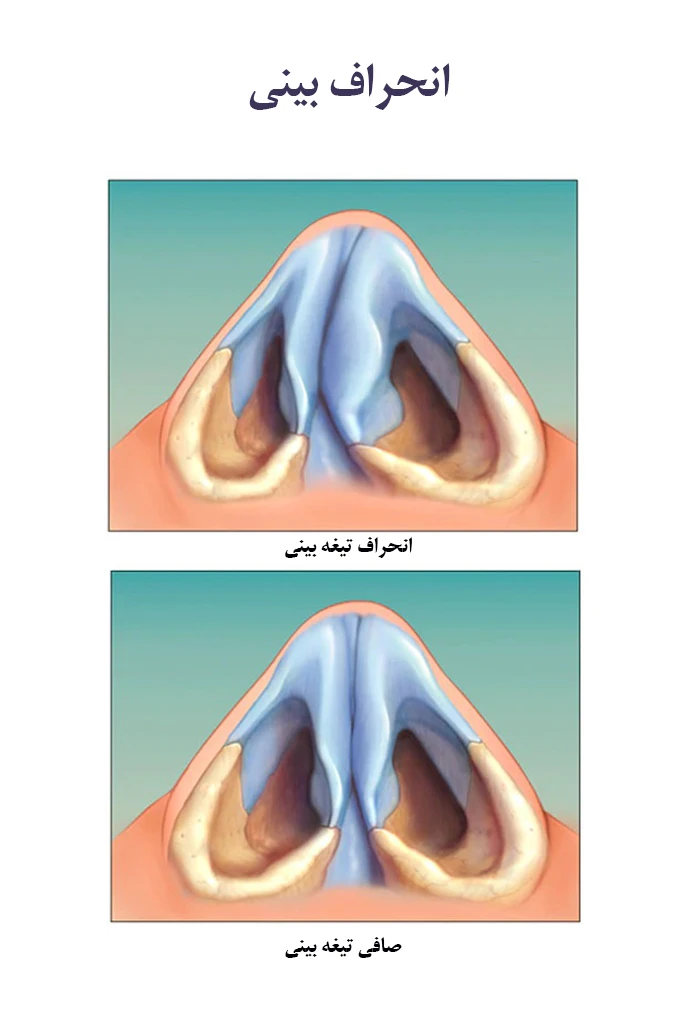 علل بروز انحراف تیغه بینی