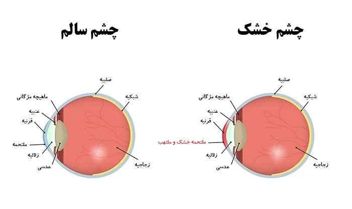 خشکی چشم چیست؟