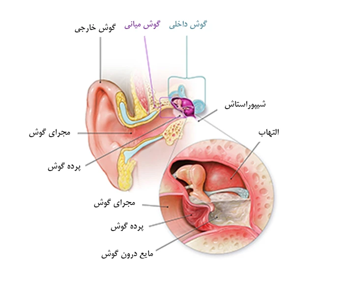 عفونت گوش (گوش میانی)