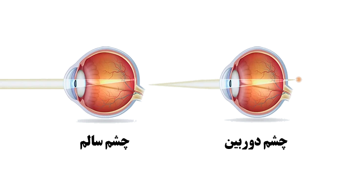 تفاوت چشم دوربین و چشم سالم